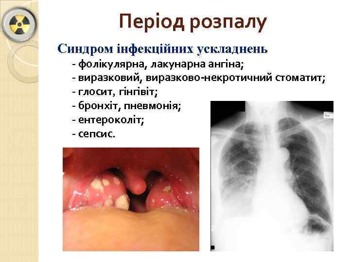 Період розпалу Синдром інфекційних ускладнень - фолікулярна, лакунарна ангіна; - виразковий, виразково-некротичний стоматит; -