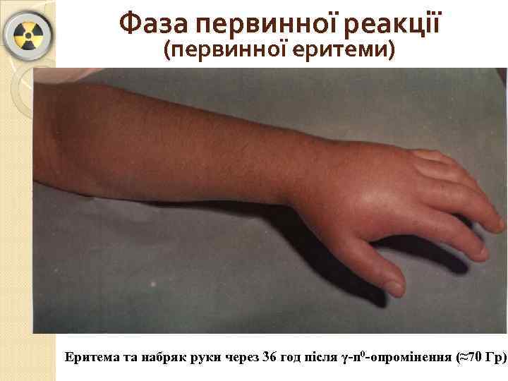 Фаза первинної реакції (первинної еритеми) Еритема та набряк руки через 36 год після γ-n