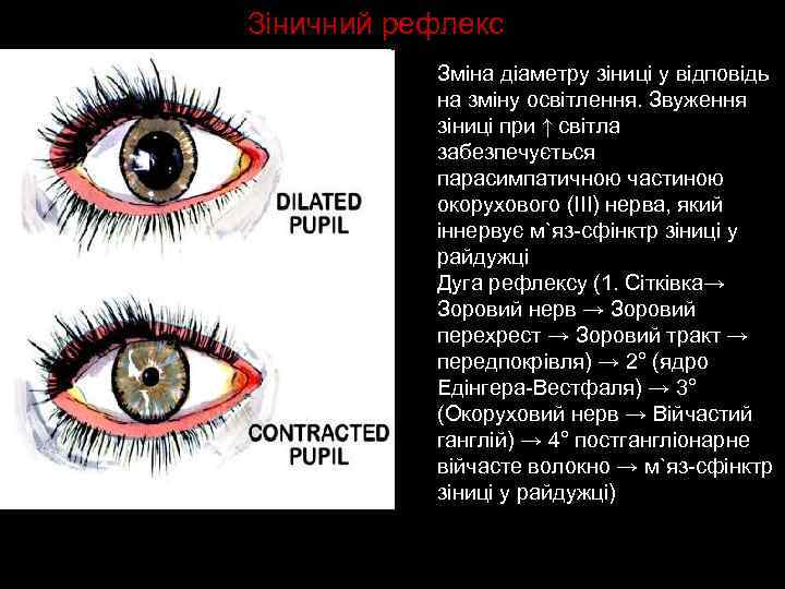 Зіничний рефлекс Зміна діаметру зіниці у відповідь на зміну освітлення. Звуження зіниці при ↑