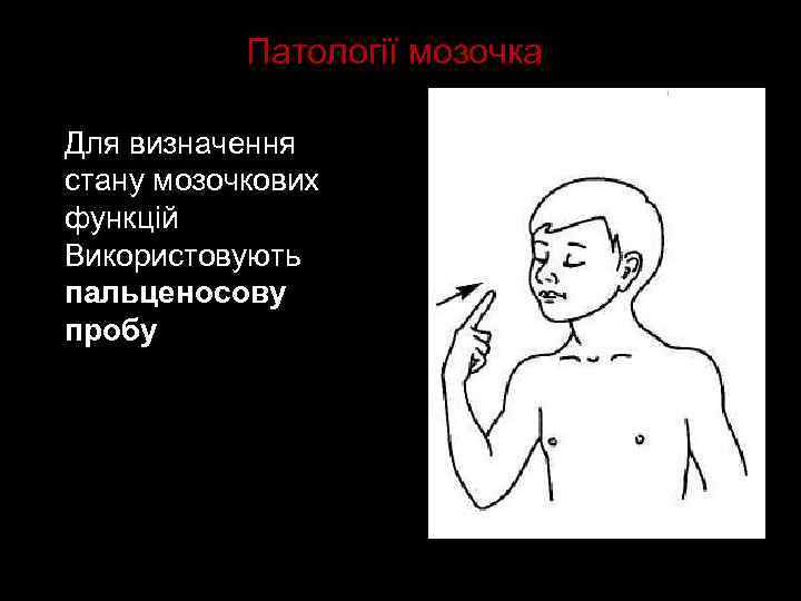 Патології мозочка Для визначення стану мозочкових функцій Використовують пальценосову пробу 