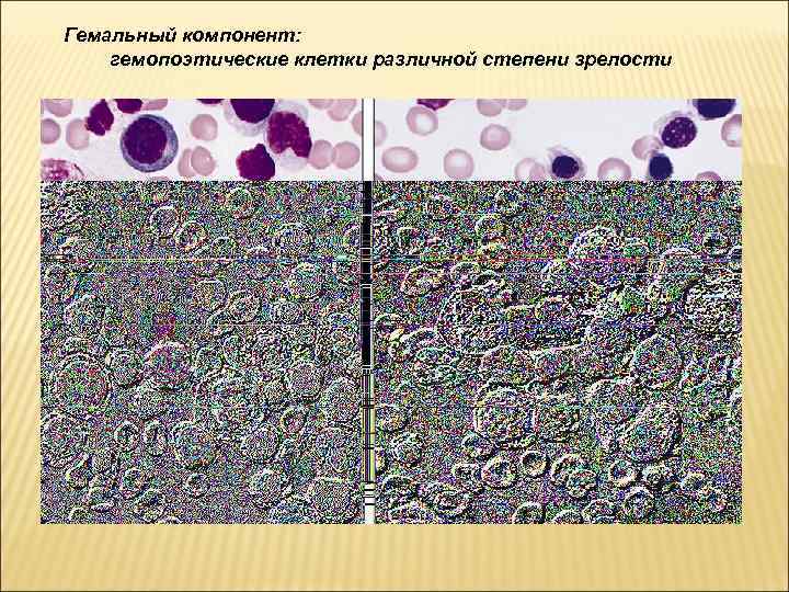 Гемальный компонент: гемопоэтические клетки различной степени зрелости 