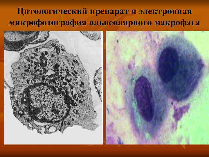 Цитологический препарат и электронная микрофотография альвеолярного макрофага 