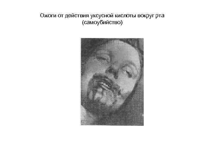 Ожоги от действия уксусной кислоты вокруг рта (самоубийство) 