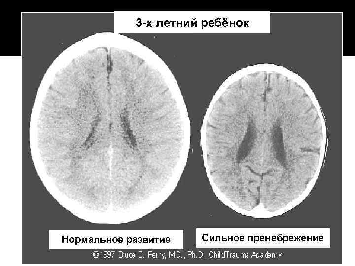 3 -х летний ребёнок Нормальное развитие Сильное пренебрежение 