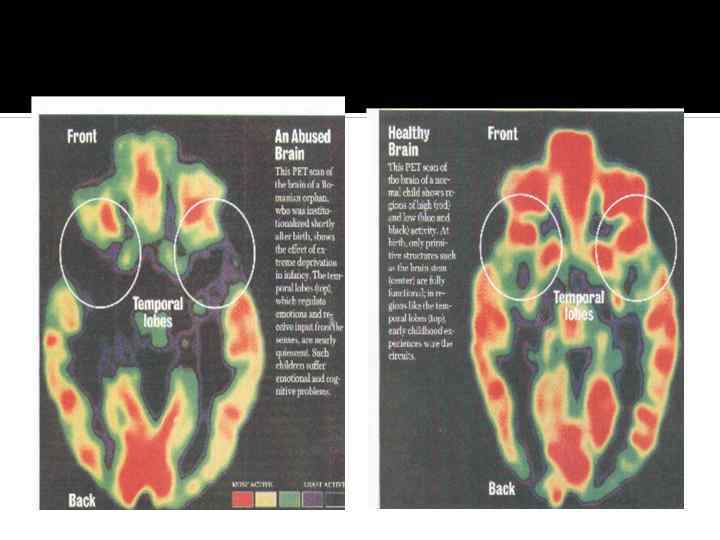 ABUSED BRAIN HEALTHY BRAIN 