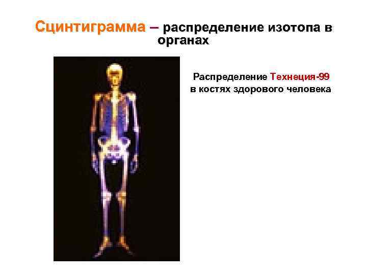 Сцинтиграмма – распределение изотопа в органах Распределение Технеция-99 в костях здорового человека 