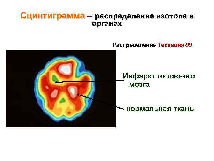 Сцинтиграмма – распределение изотопа в органах Распределение Технеция-99 Инфаркт головного мозга нормальная ткань 