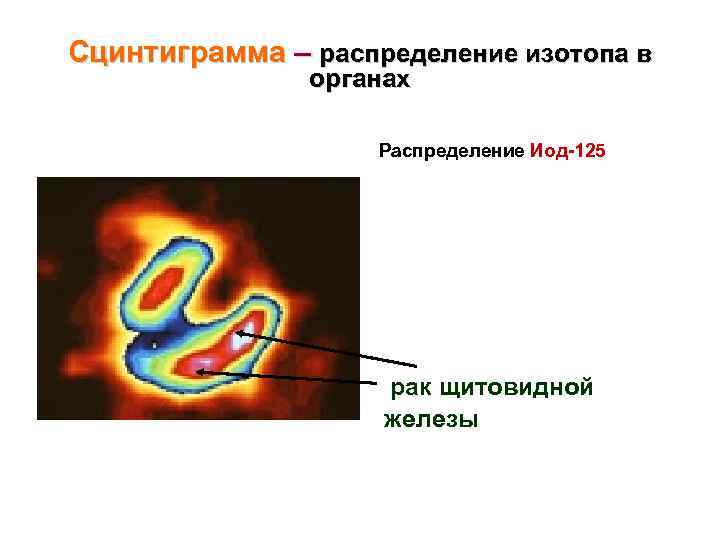 Сцинтиграмма – распределение изотопа в органах Распределение Иод-125 рак щитовидной железы 