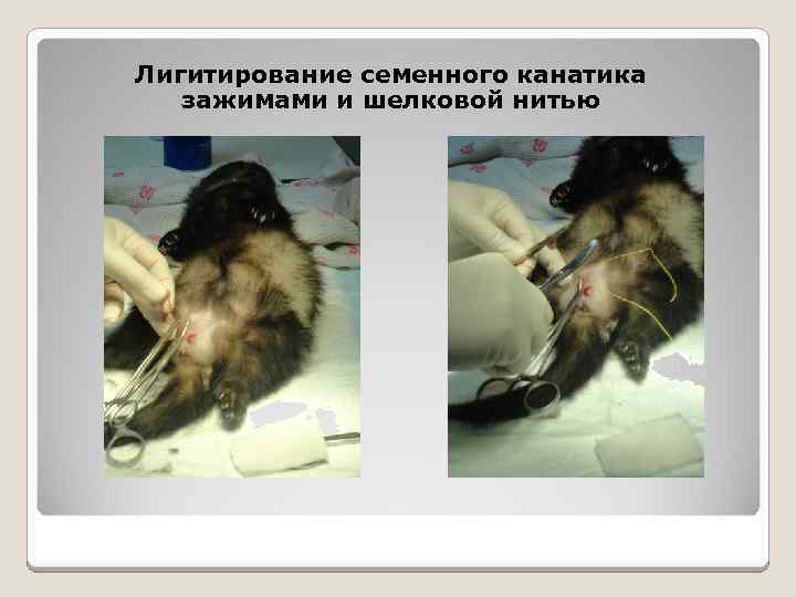 Лигитирование семенного канатика зажимами и шелковой нитью 