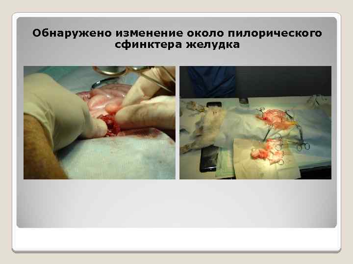 Обнаружено изменение около пилорического сфинктера желудка 