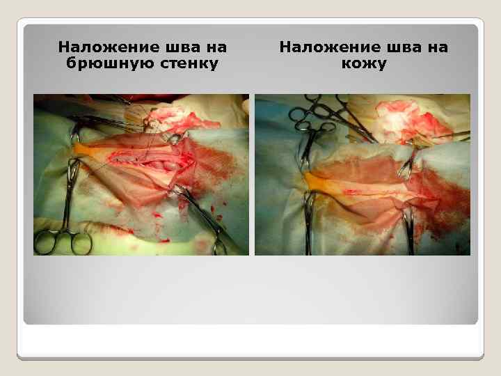 Наложение шва на брюшную стенку Наложение шва на кожу 