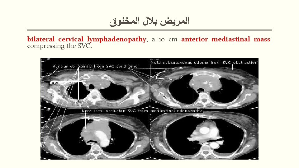  ﺍﻟﻤﺮﻳﺾ ﺑﻼﻝ ﺍﻟﻤﺨﻨﻮﻕ bilateral cervical lymphadenopathy, a 10 cm anterior mediastinal mass compressing