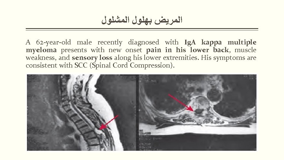  ﺍﻟﻤﺮﻳﺾ ﺑﻬﻠﻮﻝ ﺍﻟﻤﺸﻠﻮﻝ A 62 -year-old male recently diagnosed with Ig. A kappa