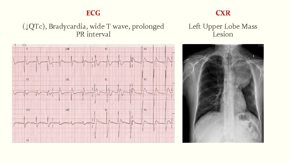 ECG CXR (↓QTc), Bradycardia, wide T wave, prolonged PR interval Left Upper Lobe Mass