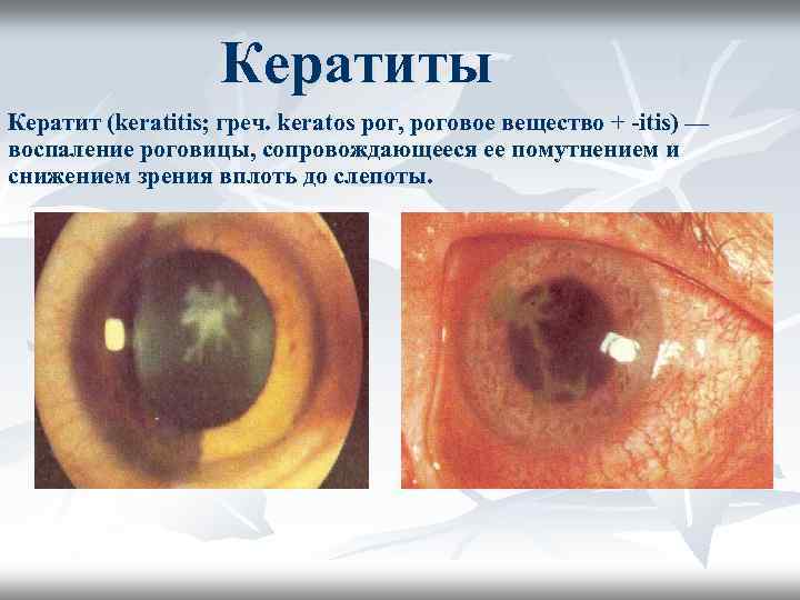 Кератиты Кератит (keratitis; греч. keratos рог, роговое вещество + -itis) — воспаление роговицы, сопровождающееся