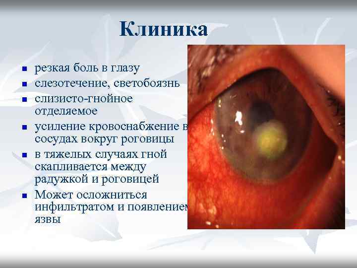 Клиника n n n резкая боль в глазу слезотечение, светобоязнь слизисто-гнойное отделяемое усиление кровоснабжение