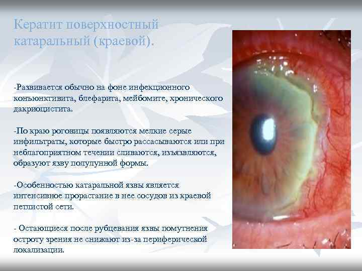 Кератит поверхностный катаральный (краевой). -Развивается обычно на фоне инфекционного конъюнктивита, блефарита, мейбомите, хронического дакриоцистита.
