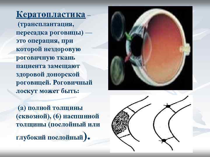 Кератопластика – (трансплантация, пересадка роговицы) — это операция, при которой нездоровую роговичную ткань пациента