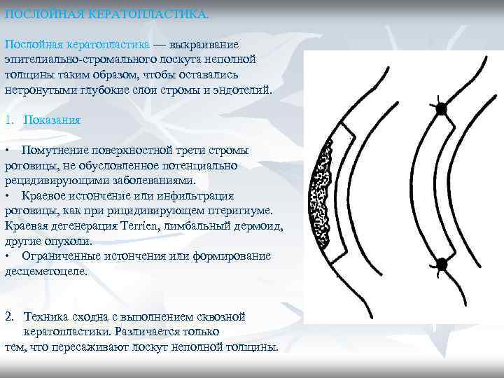 ПОСЛОЙНАЯ КЕРАТОПЛАСТИКА. Послойная кератопластика — выкраивание эпителиально-стромального лоскута неполной толщины таким образом, чтобы оставались