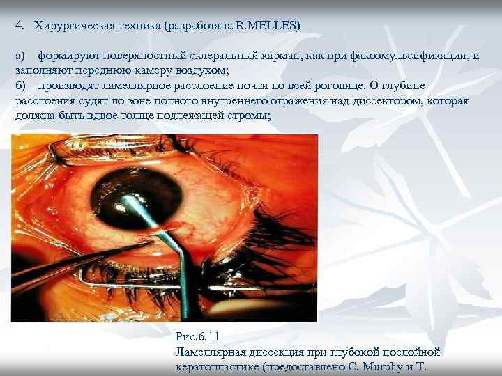 4. Хирургическая техника (разработана R. MELLES) а) формируют поверхностный склеральный карман, как при факоэмульсификации,