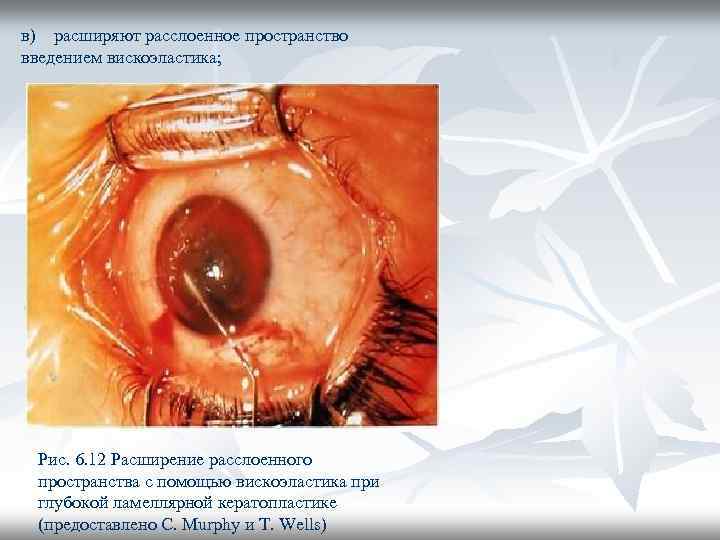 в) расширяют расслоенное пространство введением вискоэластика; Рис. 6. 12 Расширение расслоенного пространства с помощью