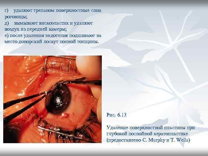 г) удаляют трепаном поверхностные слои роговицы; д) вымывают вискоэластик и удаляют воздух из передней