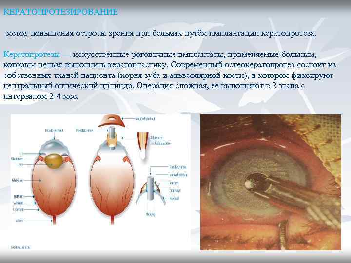 КЕРАТОПРОТЕЗИРОВАНИЕ -метод повышения остроты зрения при бельмах путём имплантации кератопротеза. Кератопротезы — искусственные роговичные