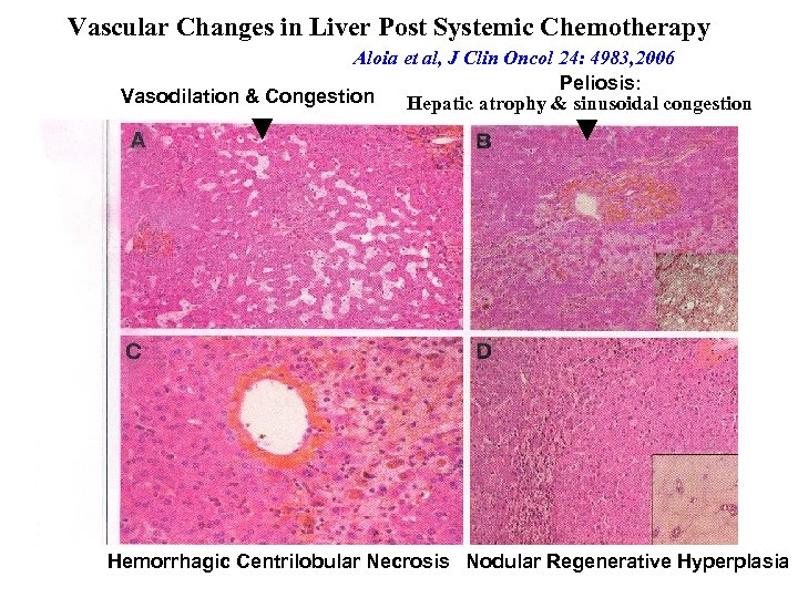 Vascular Changes in Liver Post Systemic Chemotherapy Aloia et al, J Clin Oncol 24: