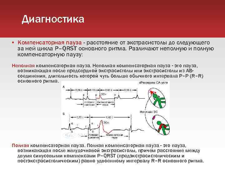 Диагностика Компенсаторная пауза - расстояние от экстрасистолы до следующего за ней цикла P–QRST основного