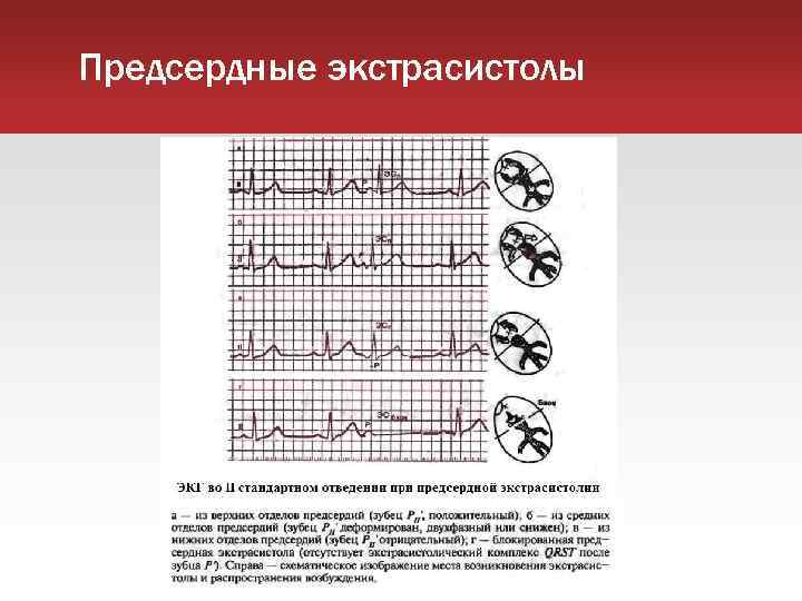 Предсердные экстрасистолы 