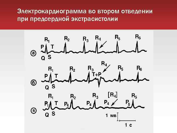 Электрокардиограмма во втором отведении предсердной экстрасистолии 