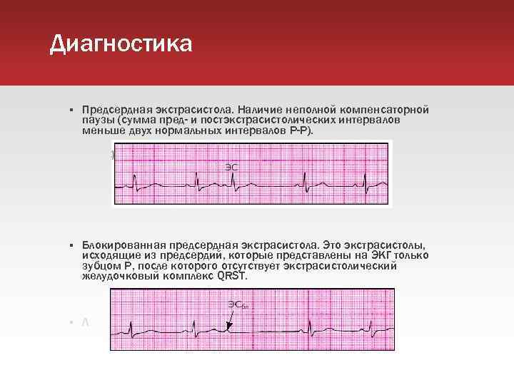 Диагностика Предсердная экстрасистола. Наличие неполной компенсаторной паузы (сумма пред- и постэкстрасистолических интервалов меньше двух