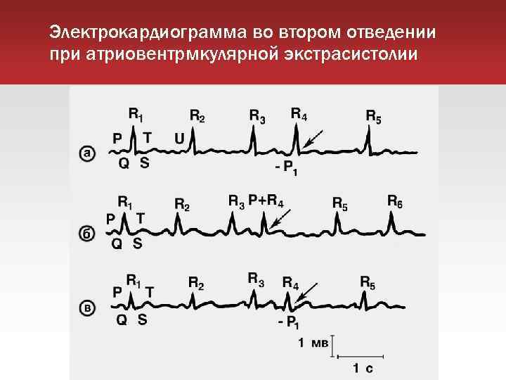 Электрокардиограмма во втором отведении при атриовентрмкулярной экстрасистолии 