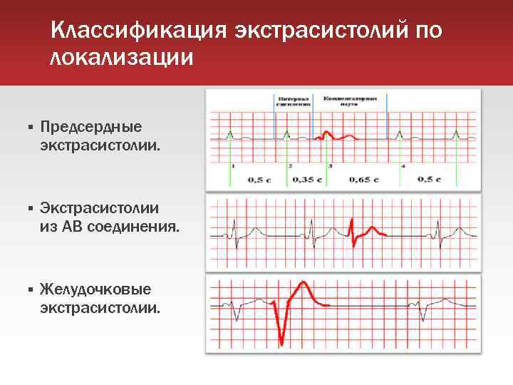 Классификация экстрасистолий по локализации Предсердные экстрасистолии. Экстрасистолии из АВ соединения. Желудочковые экстрасистолии. 