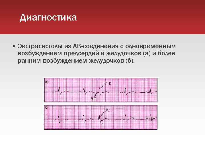 Диагностика Экстрасистолы из АВ-соединения с одновременным возбуждением предсердий и желудочков (а) и более ранним