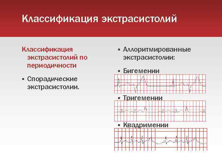 Классификация экстрасистолий по периодичности Спорадические экстрасистолии. Аллоритмированные экстрасистолии: Бигемении Тригемении Квадримении 