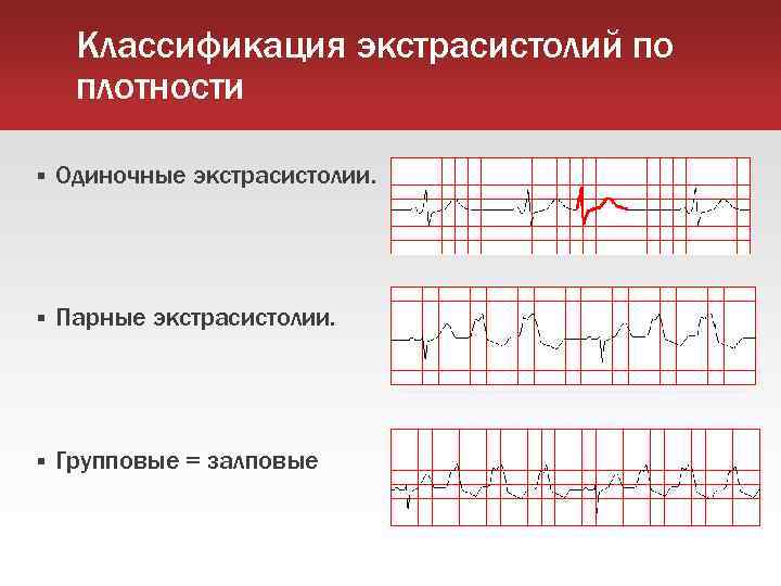 Классификация экстрасистолий по плотности Одиночные экстрасистолии. Парные экстрасистолии. Групповые = залповые 