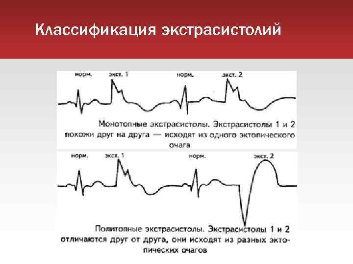 Классификация экстрасистолий 