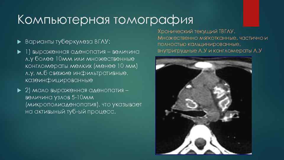 Компьютерная томография Варианты туберкулеза ВГЛУ: 1) выраженная аденопатия – величина л. у более 10