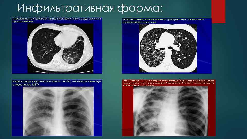 Инфильтративная форма: 