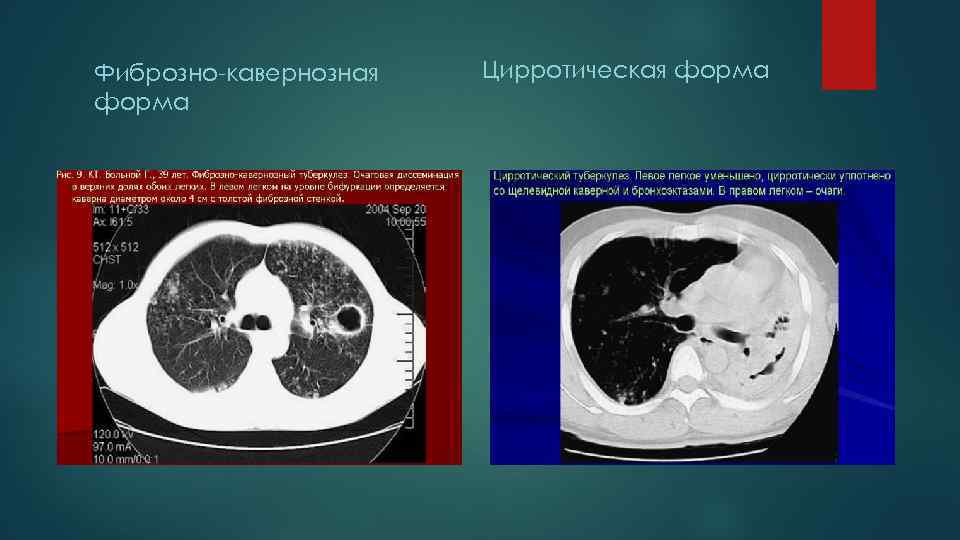 Фиброзно кавернозная форма Цирротическая форма 