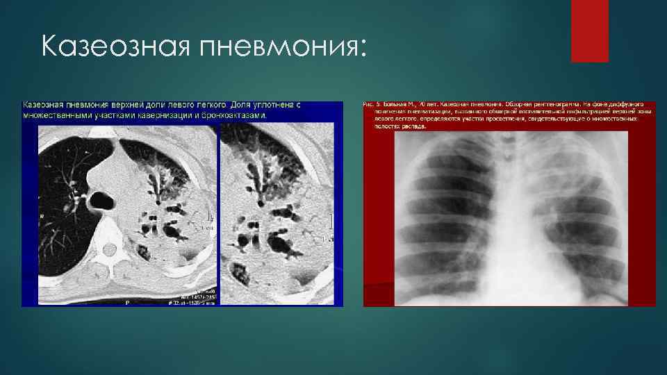 Казеозная пневмония: 