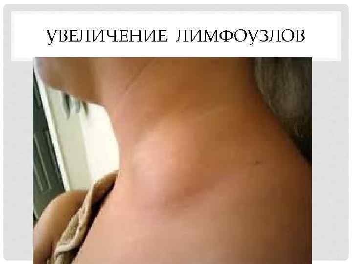 УВЕЛИЧЕНИЕ ЛИМФОУЗЛОВ 