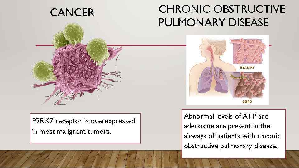 CANCER P 2 RX 7 receptor is overexpressed in most malignant tumors. CHRONIC OBSTRUCTIVE