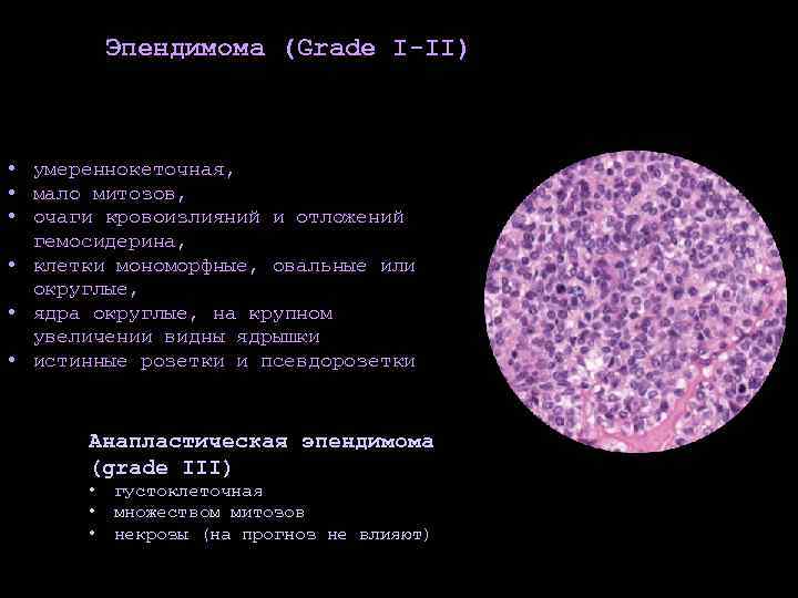 Эпендимома (Grade I-II) • умереннокеточная, • мало митозов, • очаги кровоизлияний и отложений гемосидерина,