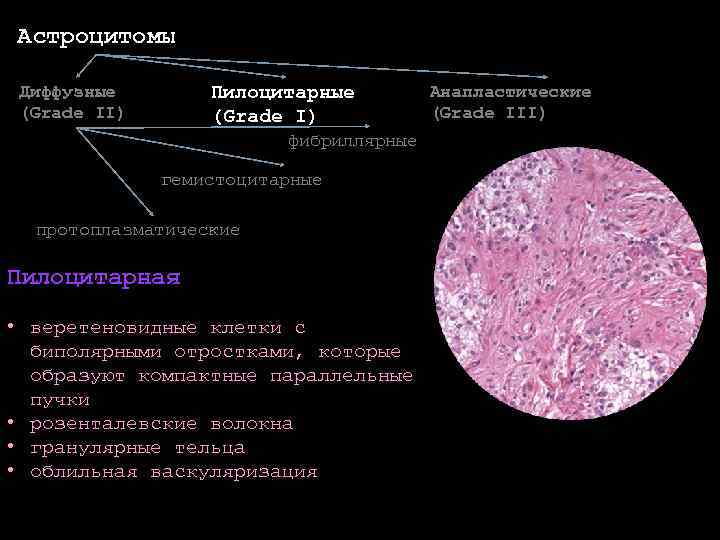 Веретеновидные клетки какая