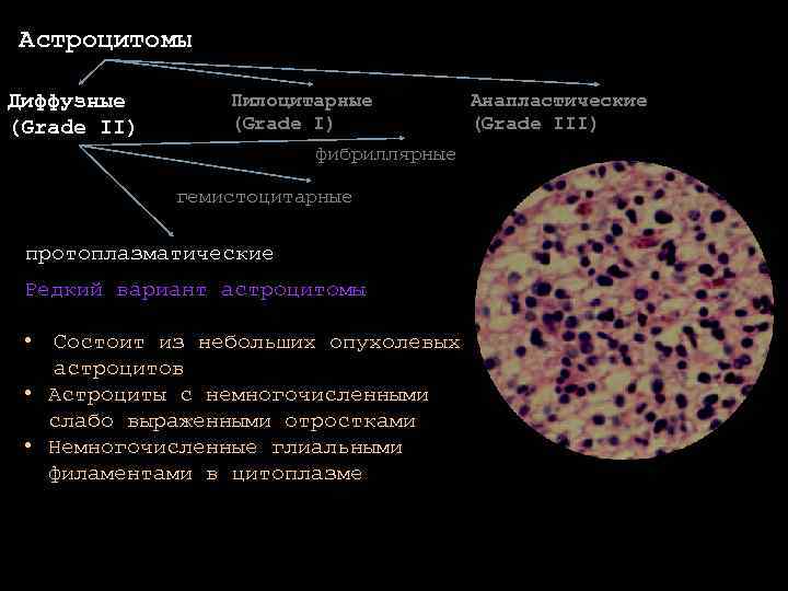 Астроцитомы Диффузные (Grade II) Пилоцитарные (Grade I) фибриллярные гемистоцитарные протоплазматические Редкий вариант астроцитомы •