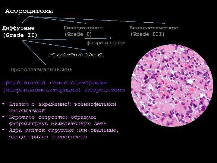 Пилоцитарная астроцитома