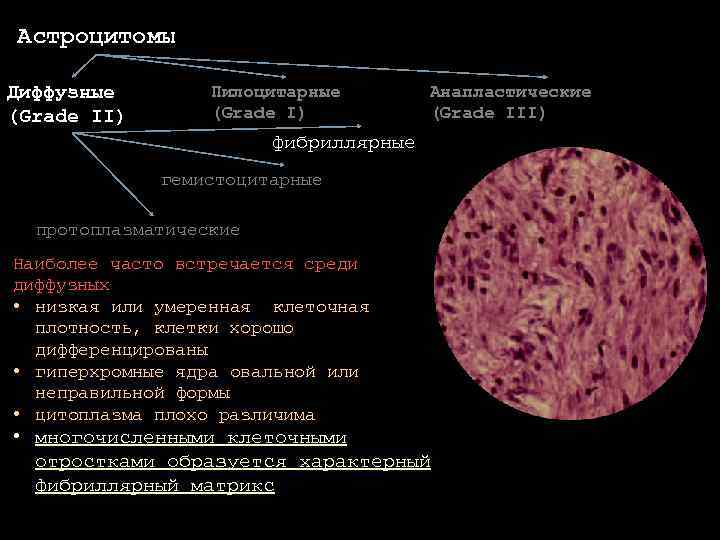 Астроцитома грейд. Пиломиксоидная астроцитома гистология. Фибриллярная астроцитома патанатомия. Протоплазматическая астроцитома. Злокачественная астроцитома гистология.