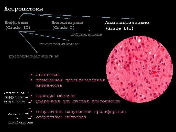 Астроцитомы Диффузные (Grade II) Пилоцитарные (Grade I) Анапластические (Grade III) фибриллярные гемистоцитарные протоплазматические •